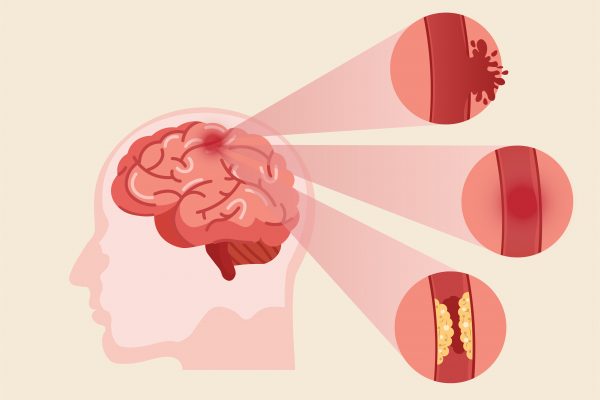 ICTUS: la mujer y el riesgo de infarto cerebral