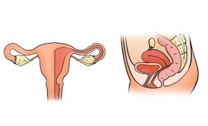 ¿Qué es y cuándo debe ser extirpado un mioma?