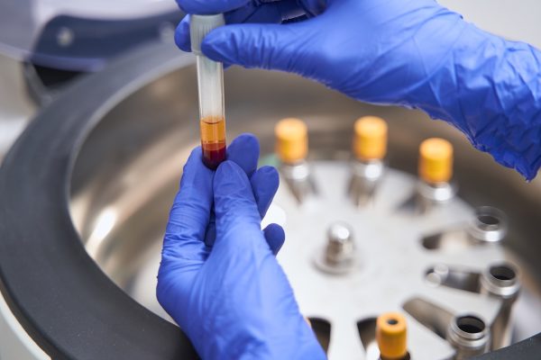 Plasma Rico en Plaquetas (PRP) en ginecología: regeneración y bienestar íntimo femenino